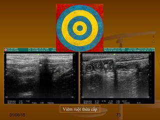 01/06/15 73
Viêm ruột thừa cấp
 