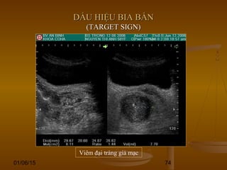 01/06/15 74
DẤU HIỆU BIA BẮNDẤU HIỆU BIA BẮN
(TARGET SIGN)(TARGET SIGN)
Viêm đại tràng giả mạc
 