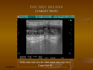 01/06/15 75
DẤU HIỆU BIA BẮNDẤU HIỆU BIA BẮN
(TARGET SIGN)(TARGET SIGN)
Thiếu máu ruột non do viêm mạch máu mạc treo /
Lupus ban đỏ
 
