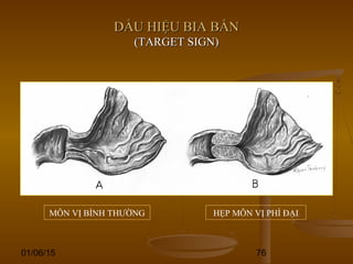 01/06/15 76
DẤU HIỆU BIA BẮNDẤU HIỆU BIA BẮN
(TARGET SIGN)(TARGET SIGN)
MÔN VỊ BÌNH THƯỜNG HẸP MÔN VỊ PHÌ ĐẠI
 