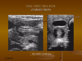 01/06/15 77
DẤU HIỆU BIA BẮNDẤU HIỆU BIA BẮN
(TARGET SIGN)(TARGET SIGN)
HẸP MÔN VỊ PHÌ ĐẠI
 