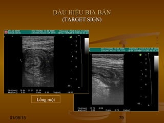 01/06/15 79
DẤU HIỆU BIA BẮNDẤU HIỆU BIA BẮN
(TARGET SIGN)(TARGET SIGN)
Lồng ruột
 