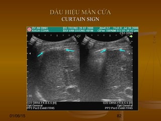 01/06/15 82
DẤU HIỆU MÀN CỬADẤU HIỆU MÀN CỬA
CURTAIN SIGNCURTAIN SIGN
 