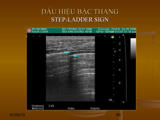 01/06/15 86
DẤU HIỆU BẬC THANGDẤU HIỆU BẬC THANG
STEP-LADDER SIGNSTEP-LADDER SIGN
 