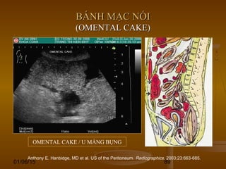 01/06/15 89
BÁNH MẠC NỐIBÁNH MẠC NỐI
(OMENTAL CAKE)(OMENTAL CAKE)
Anthony E. Hanbidge, MD et al. US of the Peritoneum. Radiographics. 2003;23:663-685.
OMENTAL CAKE / U MÀNG BỤNG
 