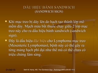 01/06/15 93
DẤU HIỆU BÁNH SANDWICHDẤU HIỆU BÁNH SANDWICH
(SANDWICH SIGN)(SANDWICH SIGN)
 Khi mạc treo bị dày lên do hạch tạo thành lớp môKhi mạc treo bị dày lên do hạch tạo thành lớp mô
mềm dày. Mạch máu bắt thuốc chạy giữa 2 lớp mạcmềm dày. Mạch máu bắt thuốc chạy giữa 2 lớp mạc
treo này cho ra dấu hiệu bánh sandwich (sandwichtreo này cho ra dấu hiệu bánh sandwich (sandwich
sign).sign).
 Đây là dấu hiệuĐây là dấu hiệu đặc hiệuđặc hiệu cho Lymphoma mạc treocho Lymphoma mạc treo
(Mesenteric Lymphomas), bệnh này có thể gây ra(Mesenteric Lymphomas), bệnh này có thể gây ra
từng mảng hạch phì đại như thế mà có thể chưa cótừng mảng hạch phì đại như thế mà có thể chưa có
triệu chứng lâm sàng.triệu chứng lâm sàng.
Seth M. Hardy, MD. The Sandwich Sign. Radiology 2003;226:651-652.
 