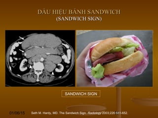 01/06/15 95
DẤU HIỆU BÁNH SANDWICHDẤU HIỆU BÁNH SANDWICH
(SANDWICH SIGN)(SANDWICH SIGN)
Seth M. Hardy, MD. The Sandwich Sign. Radiology 2003;226:651-652.
SANDWICH SIGN
 