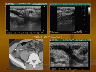 01/06/15 99
VIÊM RUỘT THỪA CẤP
 