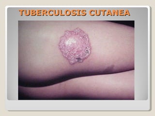 TUBERCULOSIS CUTANEA 