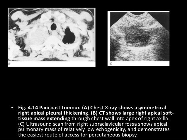 4 tumours of the lung