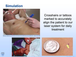 ©2011 MFMER | slide-14
Simulation
Crosshairs or tattoos
marked to accurately
align the patient to our
laser system for daily
treatment
 