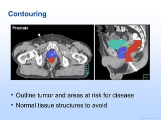 ©2011 MFMER | slide-15
Contouring
• Outline tumor and areas at risk for disease
• Normal tissue structures to avoid
Prostate
 