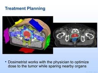 ©2011 MFMER | slide-16
Treatment Planning
• Dosimetrist works with the physician to optimize
dose to the tumor while sparing nearby organs
 