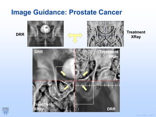 ©2011 MFMER | slide-19
Image Guidance: Prostate Cancer
DRR
DRR
Treatment
XRay
Treatment
XRay
Treatment
XRay
DRR
 