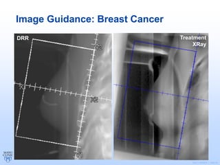 ©2011 MFMER | slide-24
Image Guidance: Breast Cancer
DRR Treatment
XRay
 