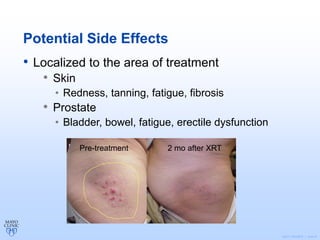 ©2011 MFMER | slide-8
Potential Side Effects
• Localized to the area of treatment
• Skin
• Redness, tanning, fatigue, fibrosis
• Prostate
• Bladder, bowel, fatigue, erectile dysfunction
Pre-treatment 2 mo after XRT
 