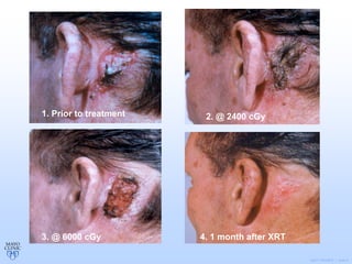 ©2011 MFMER | slide-9
1. Prior to treatment 2. @ 2400 cGy
3. @ 6000 cGy 4. 1 month after XRT
 