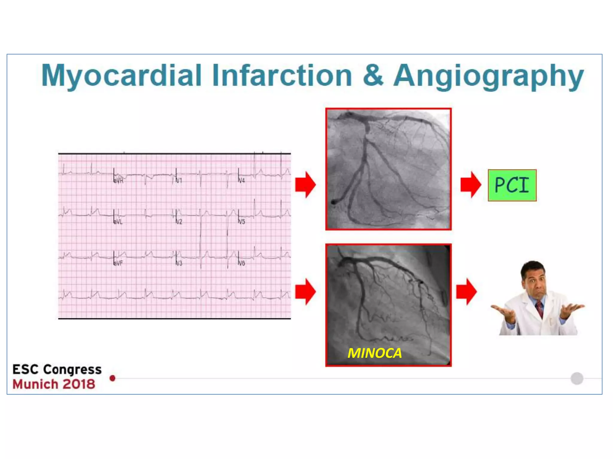 Fourth Universal Definition Of Myocardial Infarction (2018) | PPTX