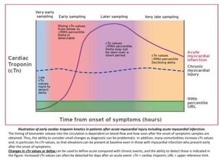 Fourth Universal Definition Of Myocardial Infarction (2018) | PPTX