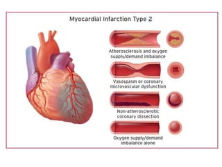 Fourth Universal Definition Of Myocardial Infarction (2018) | PPTX