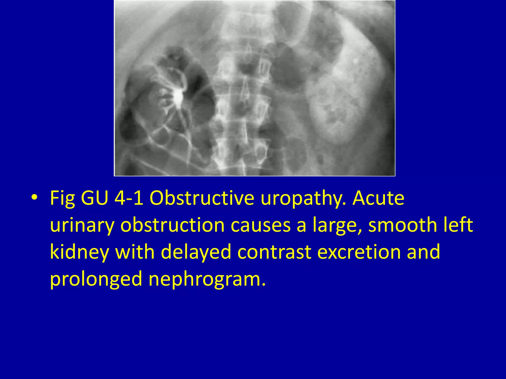 4 unilateral large, smooth kidney | PPTX