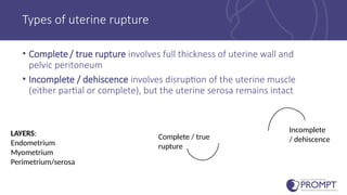 Management of Uterine rupture, obstetric Emergency.pptx