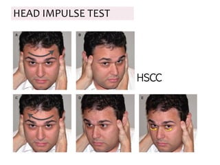 HEAD IMPULSE TEST
HSCC
 