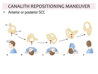 CANALITH REPOSITIONING MANEUVER
• Anterior or posterior SCC
 