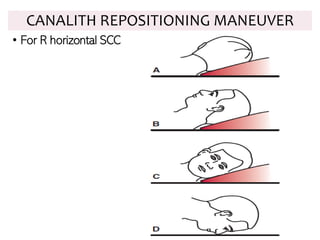 • For R horizontal SCC
CANALITH REPOSITIONING MANEUVER
 