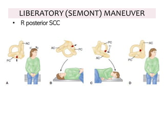 LIBERATORY (SEMONT) MANEUVER
• R posterior SCC
 