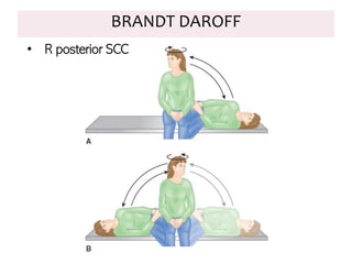 BRANDT DAROFF
• R posterior SCC
 