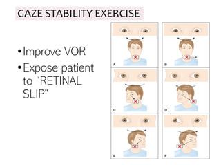 GAZE STABILITY EXERCISE
•Improve VOR
•Expose patient
to “RETINAL
SLIP”
 