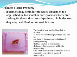Process Tissue Properly 
Specimens may be under-processed (specimen too 
large, schedule too short) or over-processed (schedule 
too long for size and nature of specimen). In both cases 
they may be difficult or impossible to cut. 
This block of pancreas had insufficient 
fixation 
and was processed using a protocol that was 
far 
too short. It shows the typical effects of 
underprocessing 
that has resulted in considerable 
shrinkage of the specimen within the 
surrounding 
wax. The tissue was soft and mushy and was 
impossible to section. It required 
reprocessing 
 