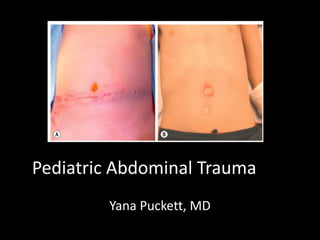 Pediatric Abdominal Trauma 
Yana Puckett, MD 
 
