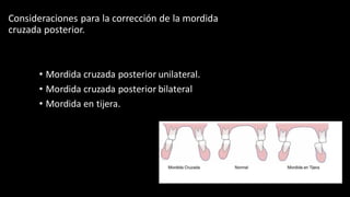 Consideraciones para la corrección de la mordida
cruzada posterior.
• Mordida cruzada posterior unilateral.
• Mordida cruzada posterior bilateral
• Mordida en tijera.
 