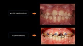 Mordida cruzada posterior.
Incisivos impactados.
 
