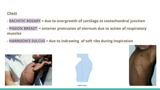 Vitamin D - sources, receptors, functions, deficiency, toxicity | PPTX
