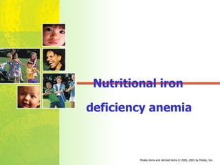 Nutritional iron deficiency anemia 