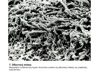 7. Οδοντική πλάκα  Βουρτσίζετε τα δόντια σας συχνά. Αυτή είναι η εικόνα της οδοντικής πλάκας της επιφάνειας ενός δοντιού. 