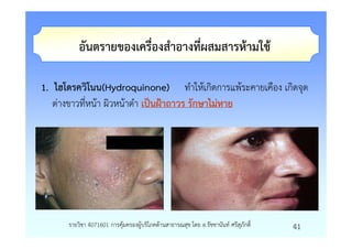 อันตรายของเครื่องสําอางที่ผสมสารหามใช

1. ไฮโดรควิโนน(Hydroquinone) ทําใหเกิดการแพระคายเคือง เกิดจุด
   ดางขาวที่หนา ผิวหนาดํา เปนฝาถาวร รักษาไมหาย




      รายวิชา 4071601 การคุมครองผูบริโภคดานสาธารณสุข โดย อ.รัชชานันท ศรีสุภักดิ์   41
 