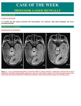 CASE OF THE WEEK
                    PROFESSOR YASSER METWALLY
CLINICAL PICTURE

CLINICAL PICTURE

A 6 months old male patient presented with macrocephaly, west syndrome, right sided hemiplegia, and severe
developmental delay.

RADIOLOGICAL FINDINGS

RADIOLOGICAL FINDINGS  




Figure 1, A case of hemimegalencephaly. Precontrast MRI T1 images showing a moderately enlarged left cerebral
hemisphere with diffuse lissencephaly, pachygyria, and cystic white matter changes. Also noted some precontrast white
matter hyperintensity probably due to defective myelination. Subcortical band heterotopias are probably present.
 