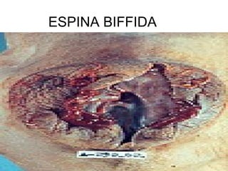 ESPINA BIFFIDA
 