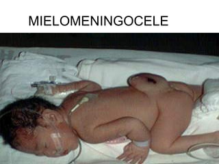 MIELOMENINGOCELE
 