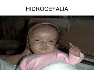 HIDROCEFALIA
 