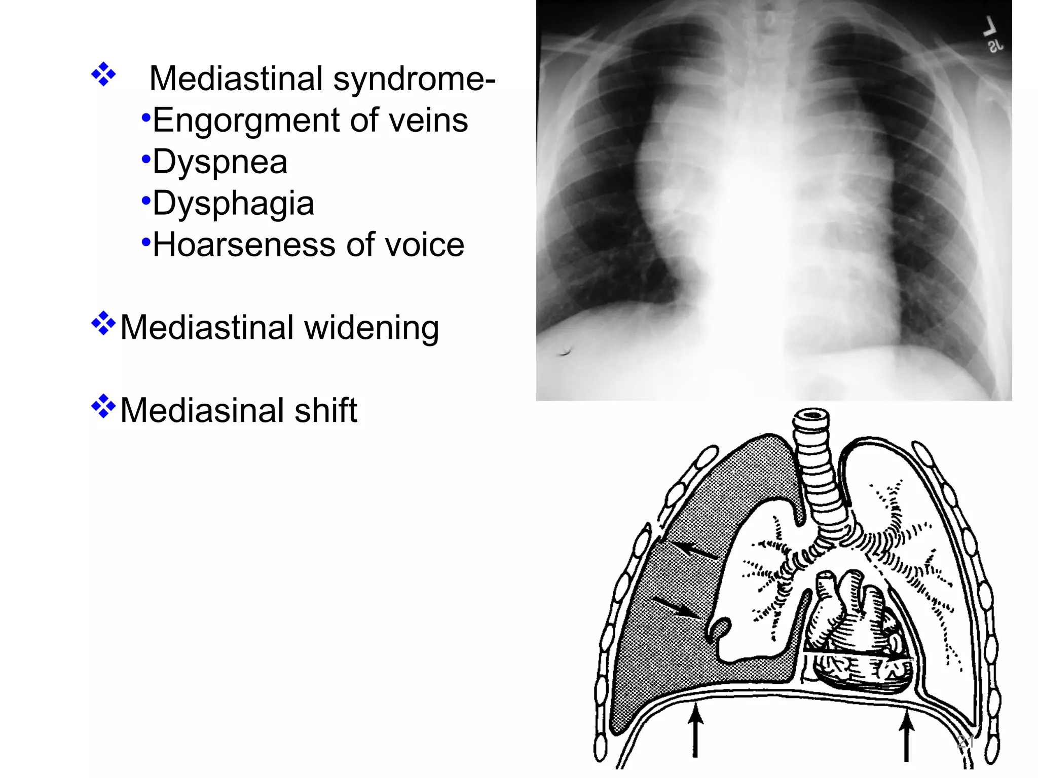  Mediastinal syndrome-
•Engorgment of veins
•Dyspnea
•Dysphagia
•Hoarseness of voice
Mediastinal widening
Mediasinal shift
21
 
