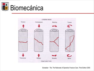 Biomecánica
Schatzker · Tile. The Rationale of Operative Fracture Care. Third Edition 2005
 