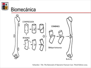 Biomecánica
Schatzker · Tile. The Rationale of Operative Fracture Care. Third Edition 2005
 