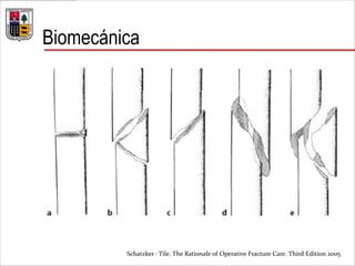 Biomecánica
Schatzker · Tile. The Rationale of Operative Fracture Care. Third Edition 2005
 
