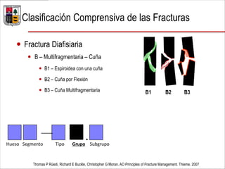  Fractura Diafisiaria
 B – Multifragmentaria – Cuña
 B1 – Espiroidea con una cuña
 B2 – Cuña por Flexión
 B3 – Cuña Multifragmentaria
Thomas P Rüedi, Richard E Buckle, Christopher G Moran. AO Principles of Fracture Management. Thieme. 2007
Clasificación Comprensiva de las Fracturas
B1 B2 B3
— .Hueso Segmento Tipo Grupo Subgrupo
 