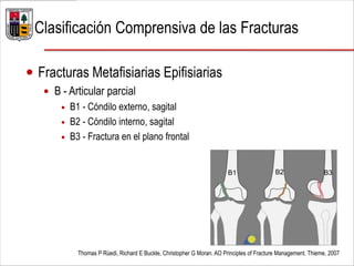  Fracturas Metafisiarias Epifisiarias
 B - Articular parcial
 B1 - Cóndilo externo, sagital
 B2 - Cóndilo interno, sagital
 B3 - Fractura en el plano frontal
Thomas P Rüedi, Richard E Buckle, Christopher G Moran. AO Principles of Fracture Management. Thieme. 2007
B1 B2 B3
Clasificación Comprensiva de las Fracturas
 